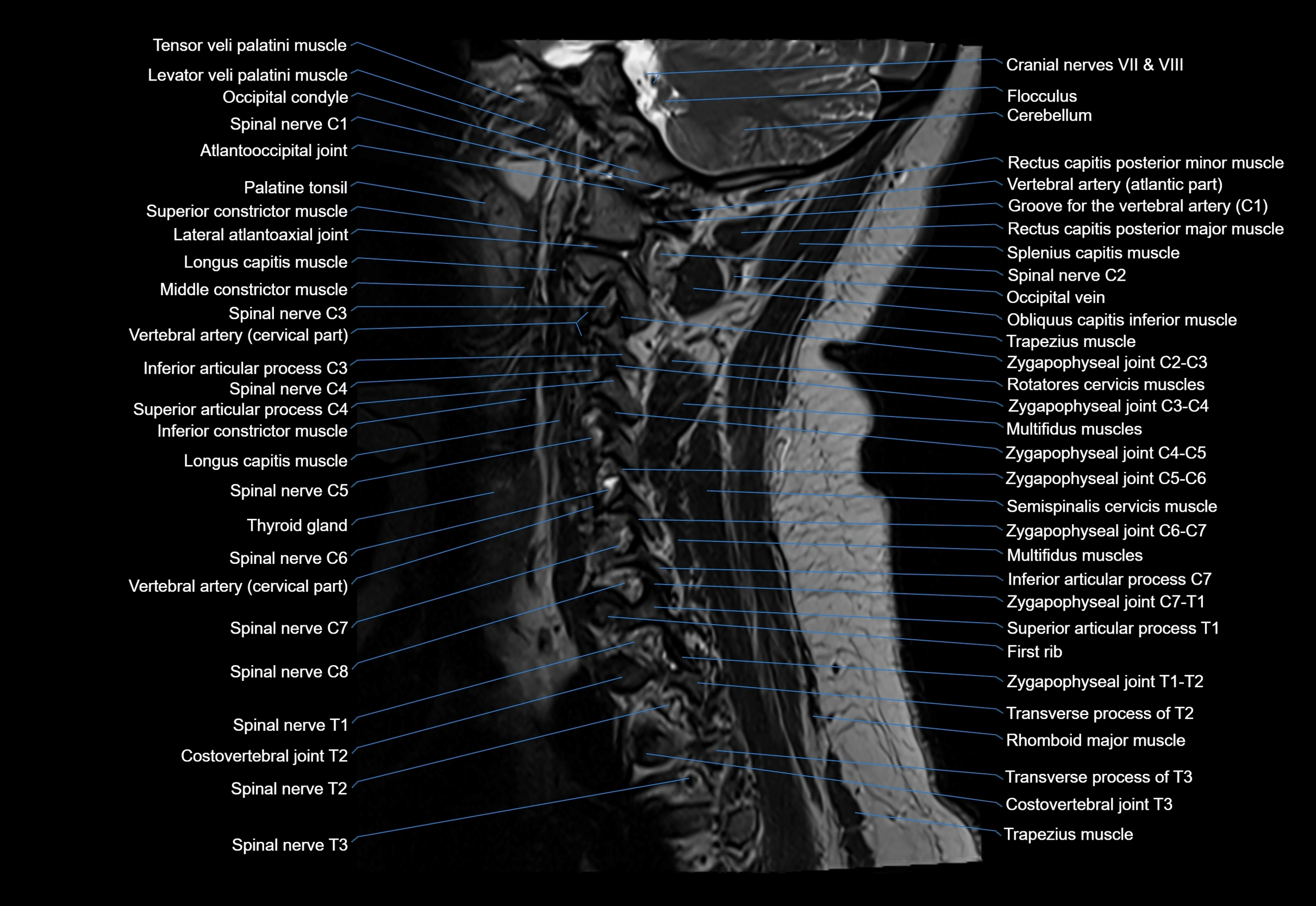 cervical spine cross sectional MRI anatomy 3T MRI  sagittal image-img-00001-00009.webp
